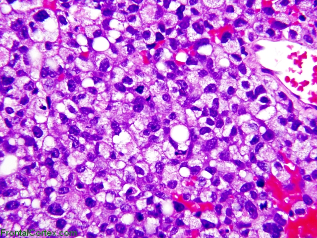 Metastatic  carcinoma, H&E stained section x 200